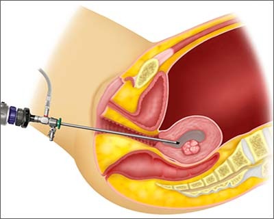 Hysteroscopic Procedures
